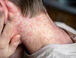 Measles Outbreak Alert: Thousands in Victoria at Risk from Exposure Sites