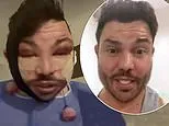 TOWIE Star Bobby Norris Worries Fans with Swollen Face After Surgery