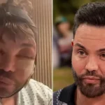 Bobby Norris Battles Insomnia After Facial Cosmetic Surgery