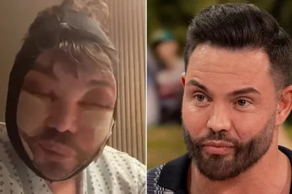 Bobby Norris Battles Insomnia After Facial Cosmetic Surgery