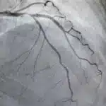 New Algorithm Detects Aortic Stenosis with 90.5% Sensitivity