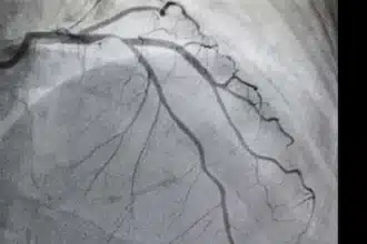 New Algorithm Detects Aortic Stenosis with 90.5% Sensitivity