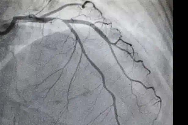 New Algorithm Detects Aortic Stenosis with 90.5% Sensitivity