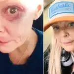 Gail Porter Shares Bruised Face After London Tube Station Fall