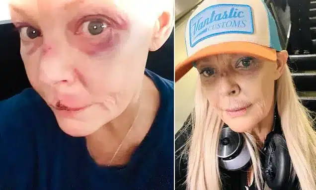 Gail Porter Shares Bruised Face After London Tube Station Fall Gail Porter Shares Bruised Face After London Tube Station Fall