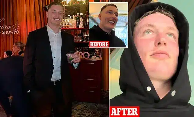 Microneedling Mishap: Man’s First Date Ruined by Red Face Microneedling Mishap: Man’s First Date Ruined by Red Face