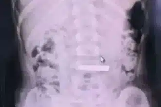 Child Hospitalized After Swallowing Valuable Gold Bar