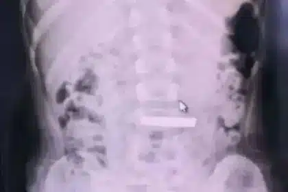 Child Hospitalized After Swallowing Valuable Gold Bar