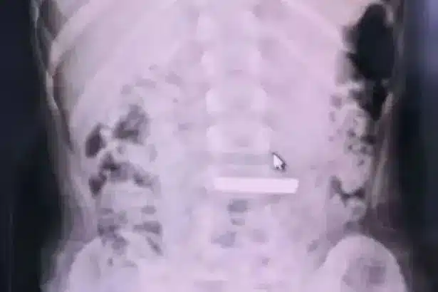 Child Hospitalized After Swallowing Valuable Gold Bar
